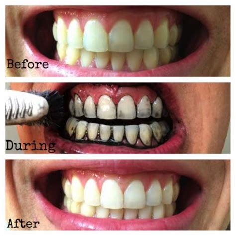 charcoal teeth whitening results